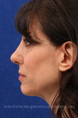 revision rhinoplasty1 after