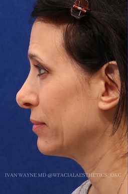 revision rhinoplasty1 before