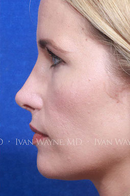 revision rhinoplasty3 after