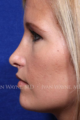 revision rhinoplasty3 before