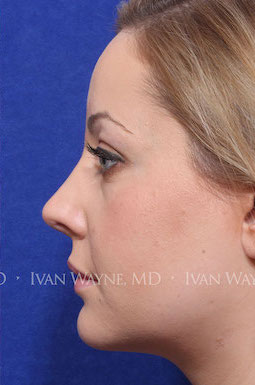 revision rhinoplasty4 after