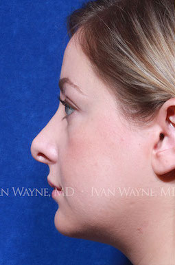 revision rhinoplasty4 before