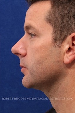 male rhinoplasty 4 after