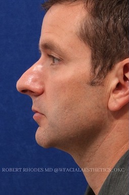 male rhinoplasty 4 before