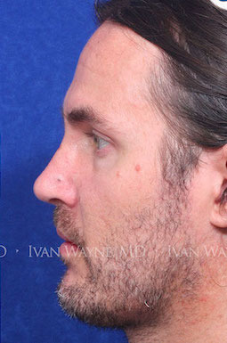 male rhinoplasty after 3