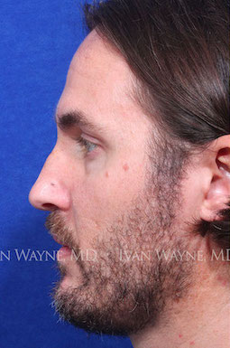 male rhinoplasty before 3