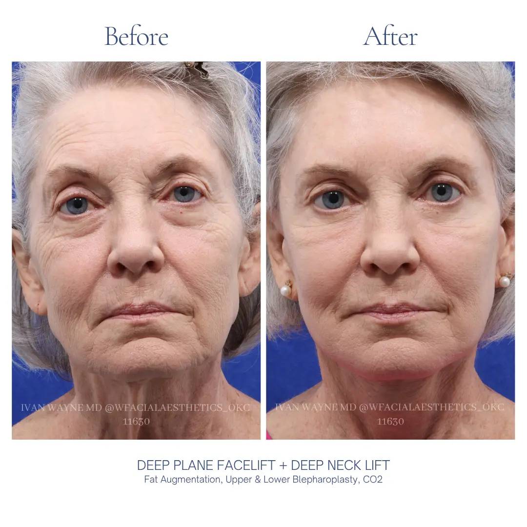 01_facelift_BA-15
