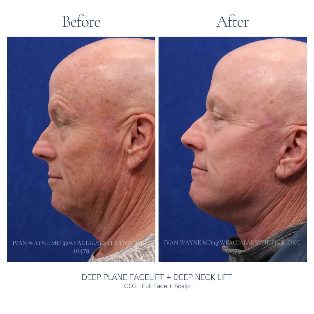 01_facelift_BA-8