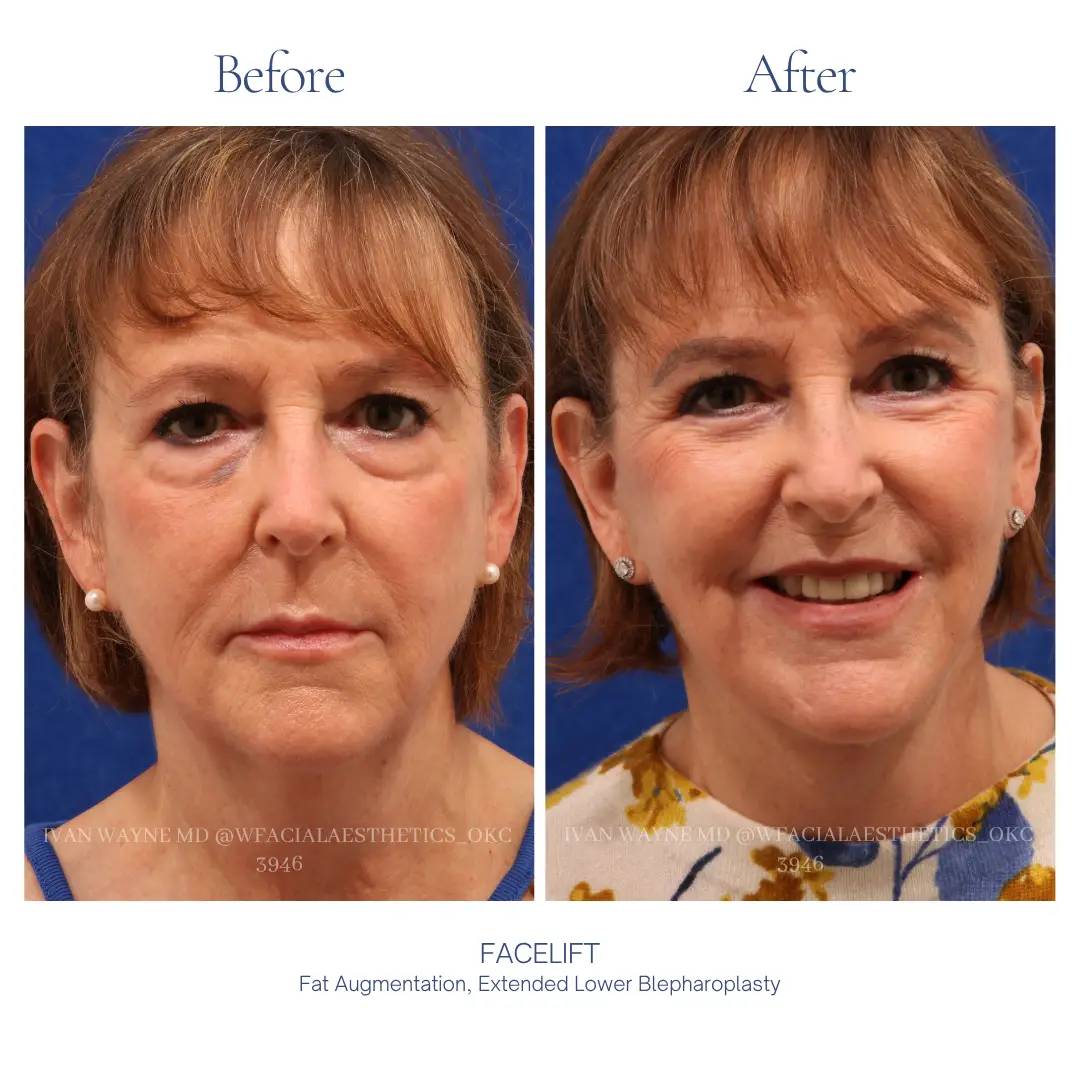 01_facelift_ba-1