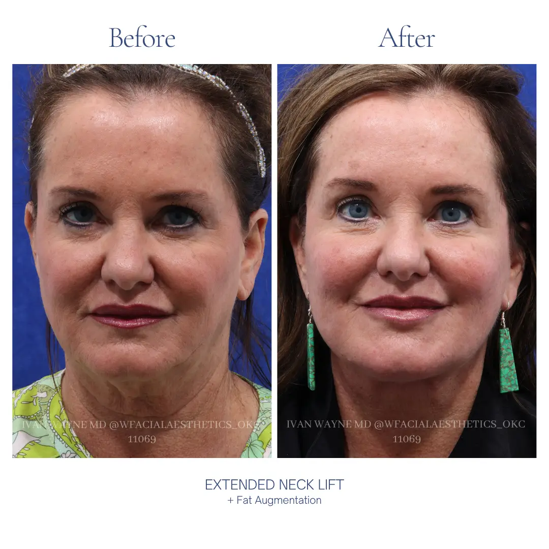 Necklift Before and After