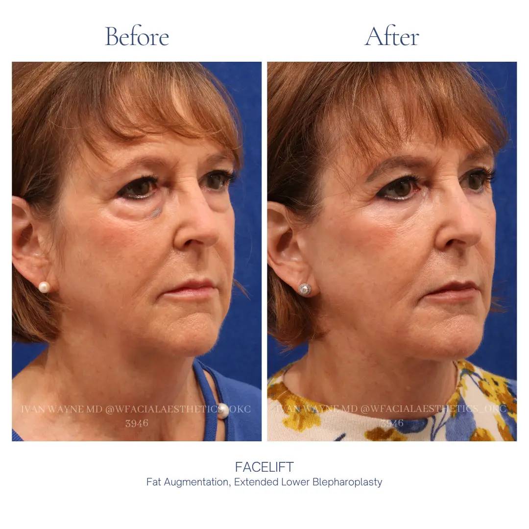 02_facelift_ba-1
