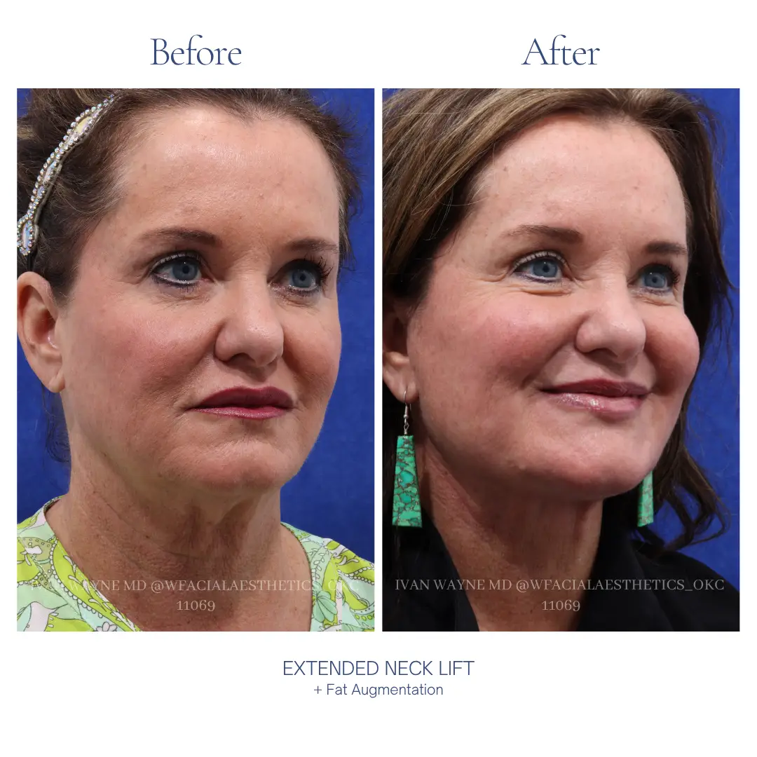 Necklift Before and After