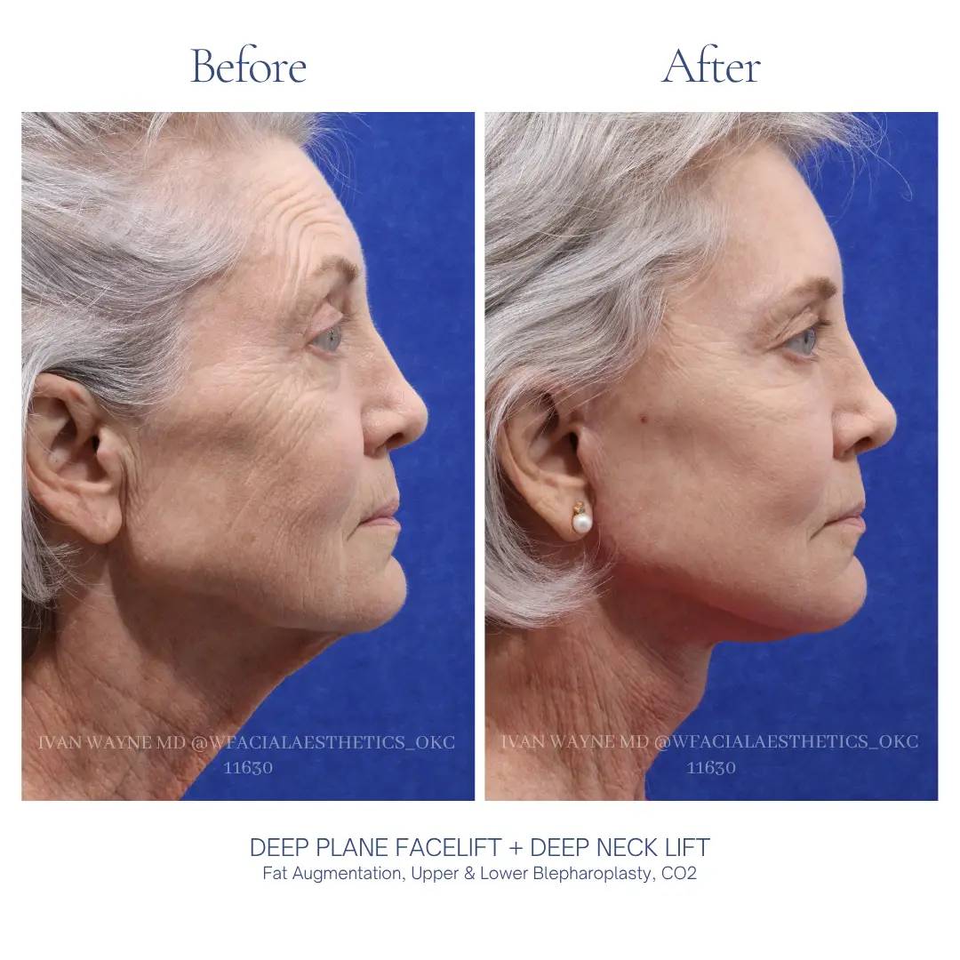 03_facelift_BA-14