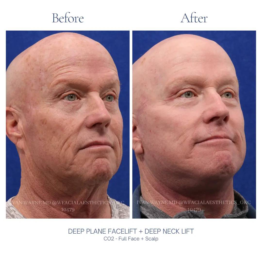 03_facelift_BA-7
