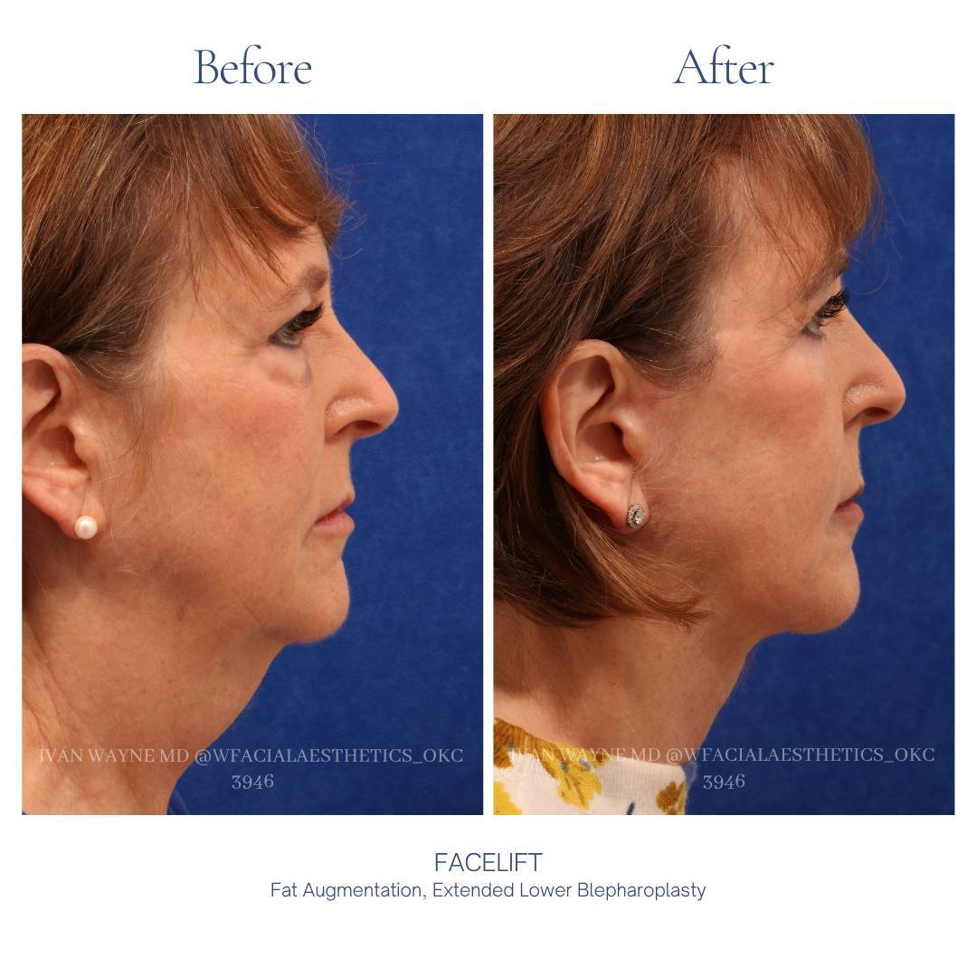 03_facelift_ba
