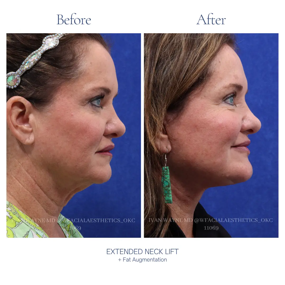 Necklift Before and After