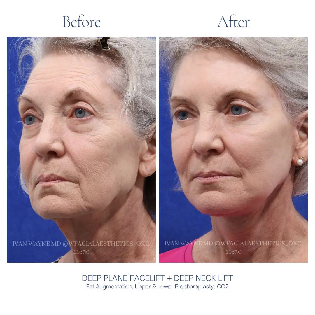 04_facelift_BA-13