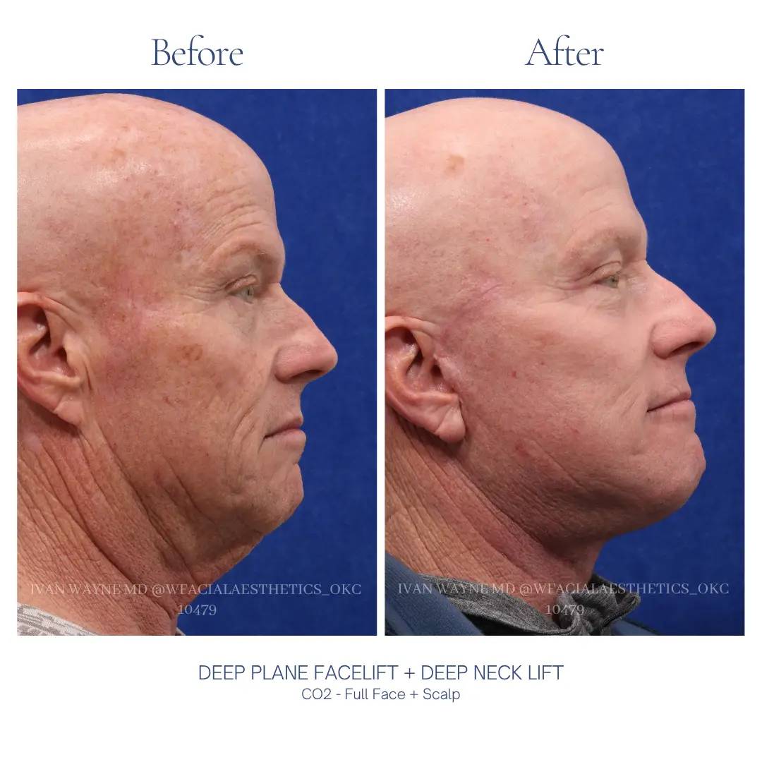 04_facelift_BA-7