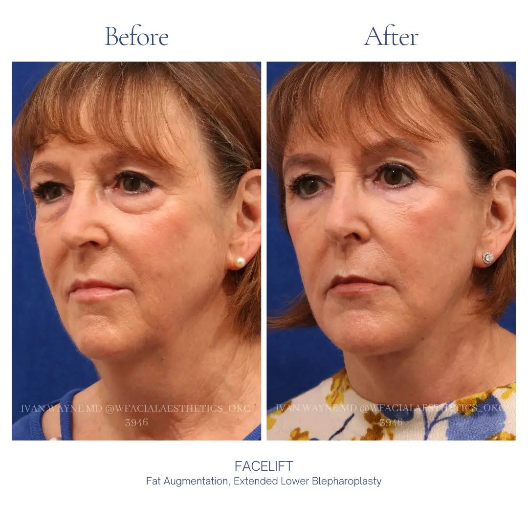 04_facelift_ba-1