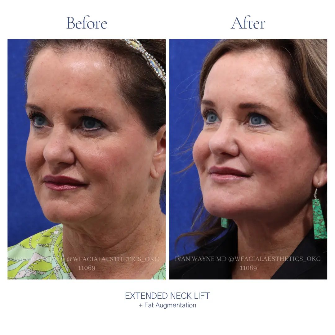Necklift Before and After
