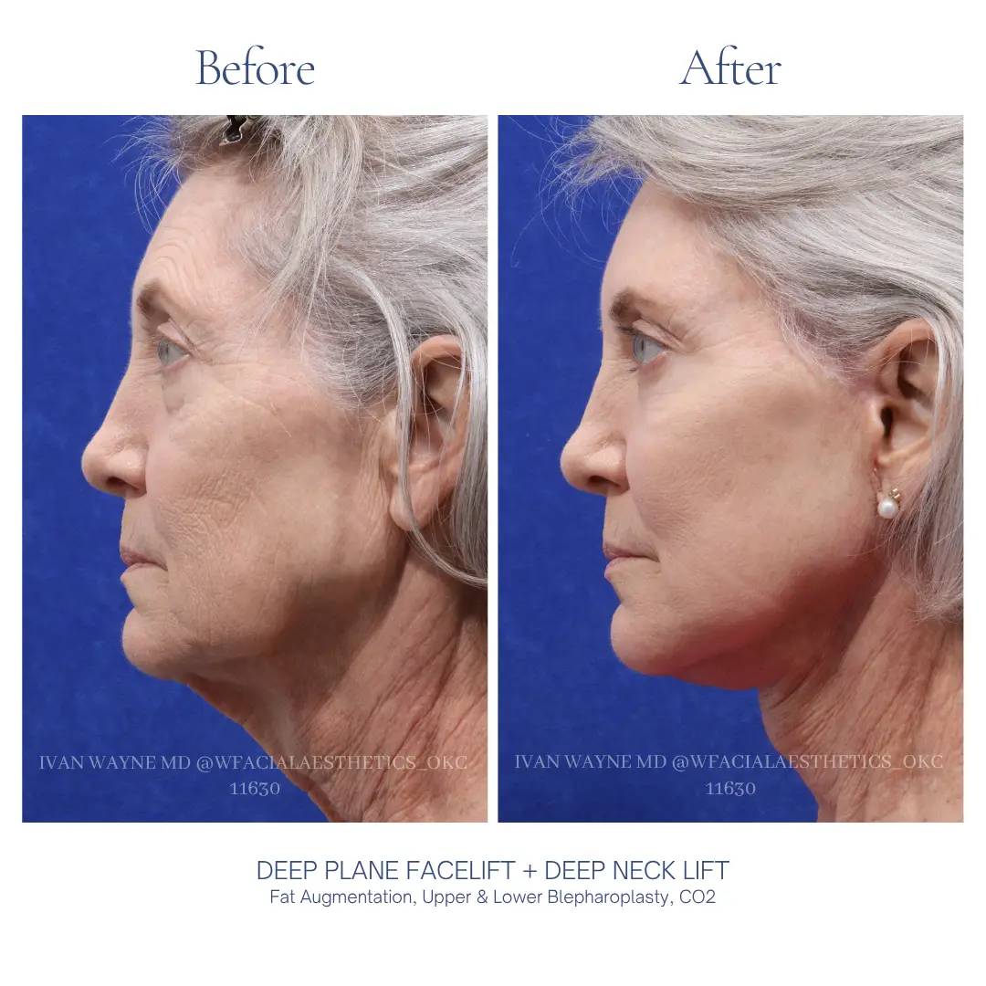 05_facelift_BA-12
