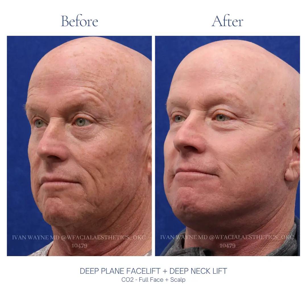 05_facelift_BA-6