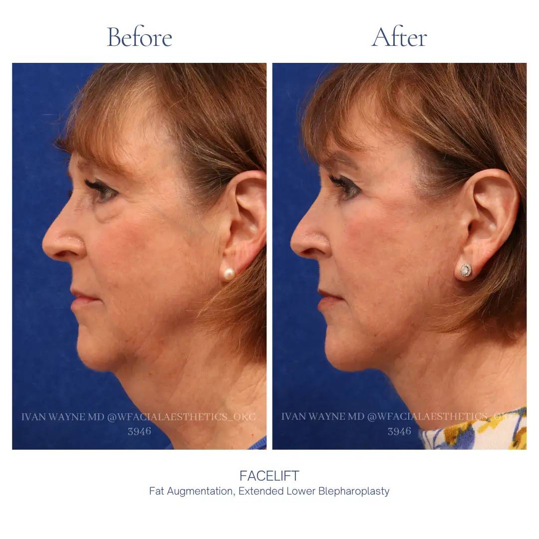 05_facelift_ba-1