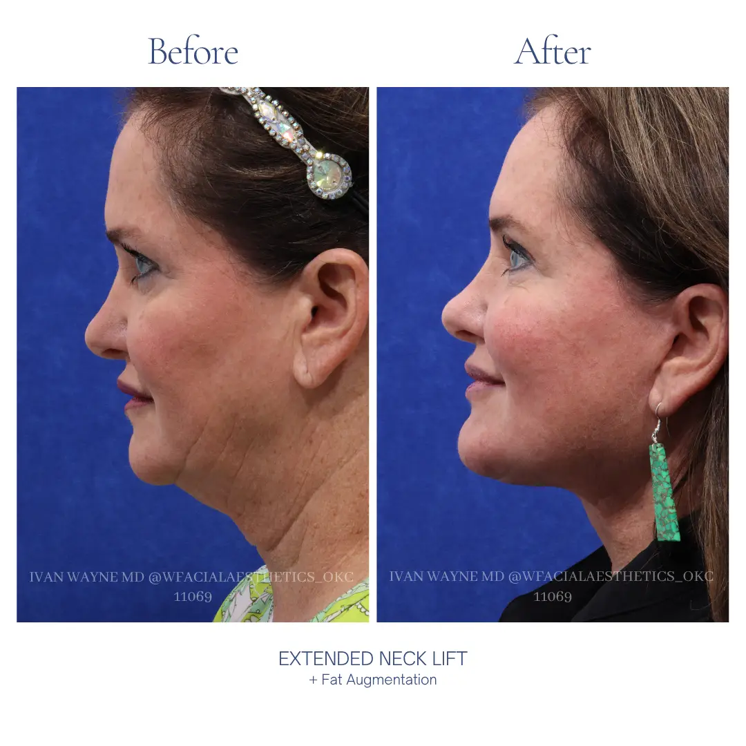 Necklift Before and After
