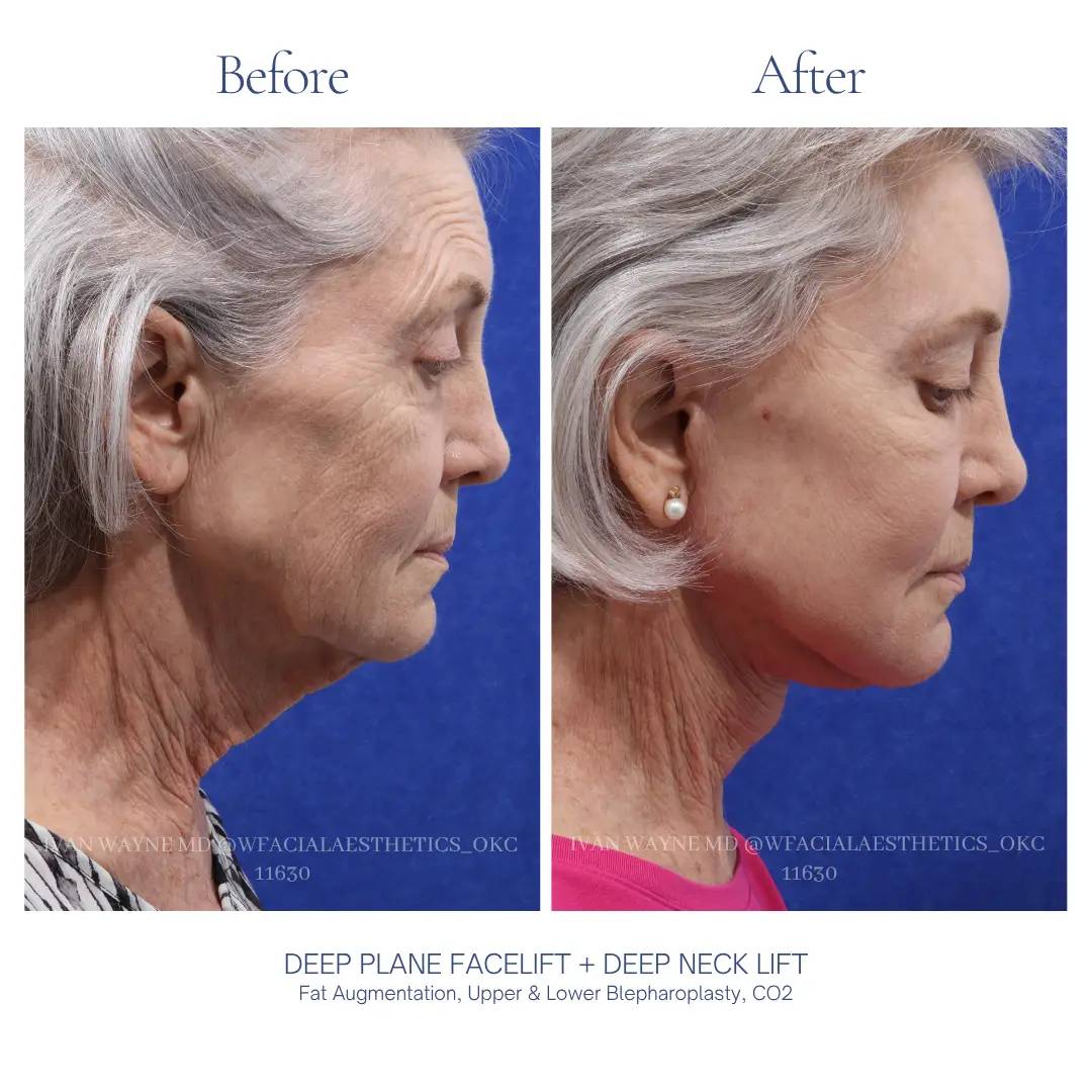 06_facelift_BA-3