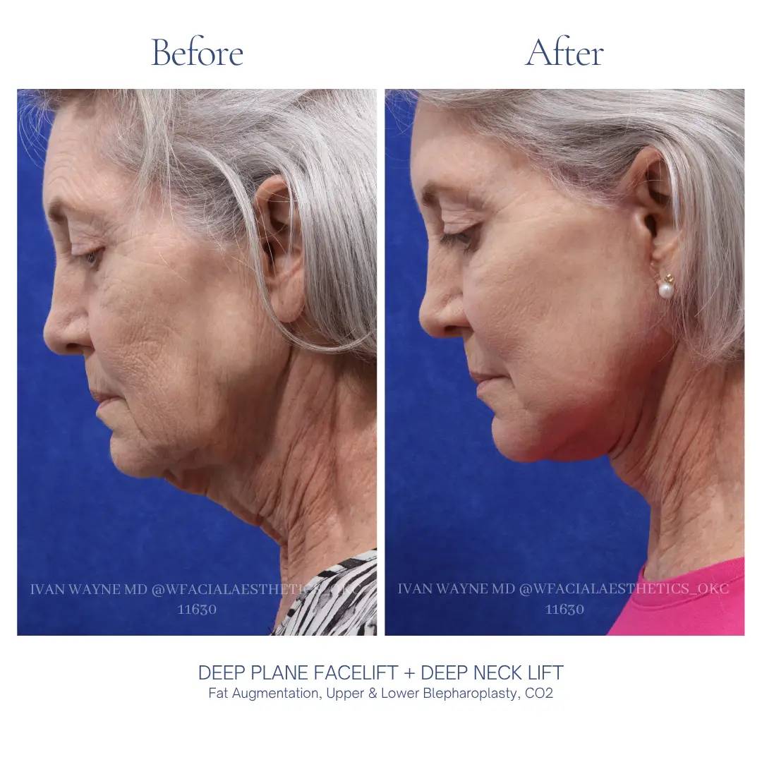 07_facelift_BA-3